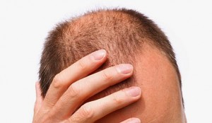 Cientistas fazem cabelo voltar a crescer em laboratório Cabeça de homem calvo