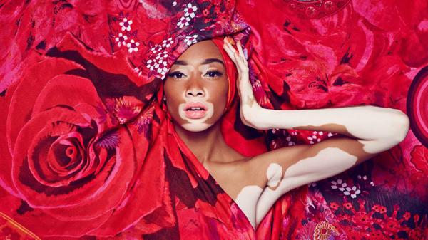 Após sofrer bullying, modelo com vitiligo quebra barreiras no mundo da moda